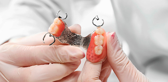Clasp dentures on the upper jaw