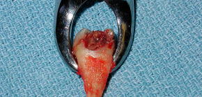 Extrakce zubu: jak se připravit na postup a jeho hlavní fáze