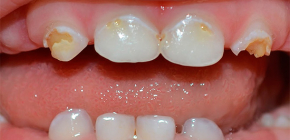 What is important to know about decay of deciduous teeth in young children