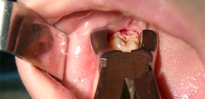 Moguće komplikacije nakon postupka vađenja zuba