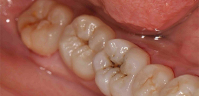 Comment reconnaître la carie dentaire: méthodes de diagnostic de base