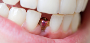 How long does a tooth implant usually serve and how soon can it be replaced
