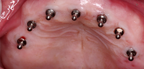 L’ús de mini implants per a la fixació de les pròtesis desmuntables