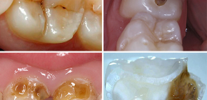 Jak může zubní kaz vypadat: fotografie