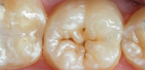 Kā pasargāt zobus no zobu samazinājuma: efektīvu metožu pārskats