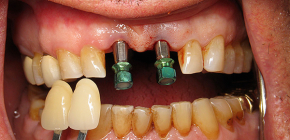 Is tandheelkundige implantatie mogelijk bij parodontitis en parodontitis?
