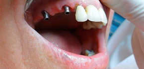 Complications and problems sometimes arising after dental implants
