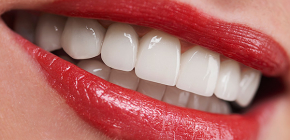 Ar yra nechirurginis dantų implantas be dantenų pjūvio?