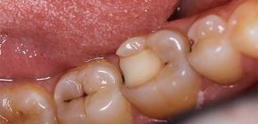 Folkrättsmedel för snabb lindring av tandvärk