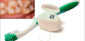 Wirksame Methoden zur Vorbeugung von Zahnkaries