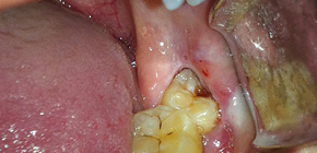 Ar būtina pašalinti išminties dantis, ar geriau pabandyti juos gydyti?