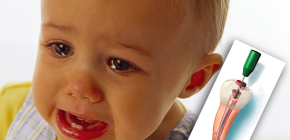 Tratamento da pulpite de dentes decíduos em crianças