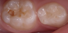 Features of the diagnosis and treatment of dentin caries