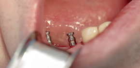 Moderné typy zubných implantátov a štandardné ceny pre tento postup