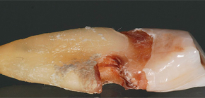 Características de la caries de la raíz del diente y su tratamiento.