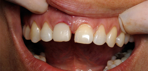 Dantų implantų atmetimo simptomai: pagal kokius požymius galima atpažinti problemą?