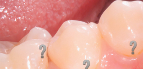 In detail about the hidden caries, as well as its examples in the photo