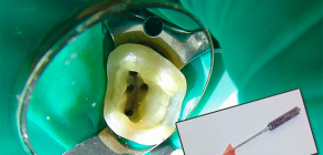 Mitä tehdä, jos hammas sattuu hermon poistamisen ja kanavien puhdistuksen jälkeen