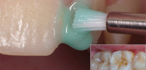 Home caries treatment: is it really possible?