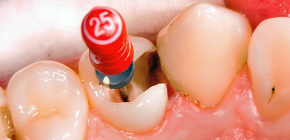 Hvorfor får en tannpine etter behandling med pulpitt, og det er vondt å bite på den?