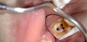 O liječenju pulpitisa trokanalnih zuba i cijenama ovog postupka