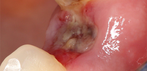 L'alveolite come una complicazione dopo l'estrazione del dente (quando il foro si sta inumidendo)
