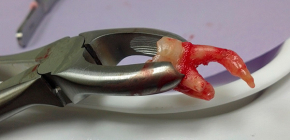 Wie viel kostet es heute, einen Zahn zu entfernen: Preisübersicht für verschiedene klinische Fälle