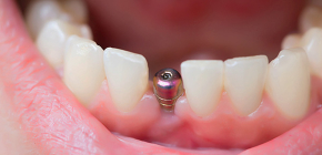 What is included in the turnkey dental implantation and what will have to be paid separately