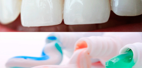 How to choose toothpaste from caries: we select the best option