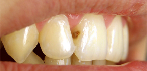 Co dělat, když se zubní kaz objevil na předních zubech