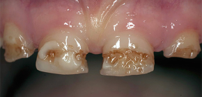 About neglected caries: what to do if there are signs of decay on almost all teeth