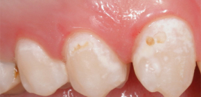 Initial caries in the spot stage and its treatment