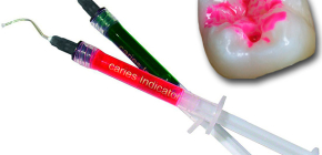 The use of caries markers (indicators) in dentistry