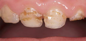 Cari de dents de fulla caduca en els nens i el seu tractament: l’important que els pares coneguin