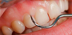 Faran för karies lokaliserad under tandköttet och funktionerna i dess behandling