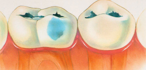 Dental caries in decompensated form