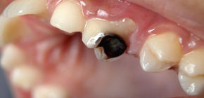 Kolik stojí léčba zubního kazu a jaké faktory ovlivňují cenu