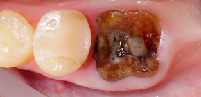 Eliminació de les arrels de la dent (quan es destrueix la part de la corona o inflamació a l’arrel)