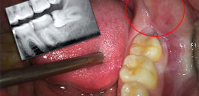 Was ist, wenn der Weisheitszahn wächst und das Zahnfleisch schmerzt?