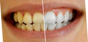 How to whiten teeth at home without harm to enamel