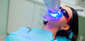 Tecnologia per lo sbiancamento dei denti, nonché i suoi vantaggi e svantaggi