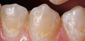 Smalt zubního kazu: od diagnózy po léčebné metody