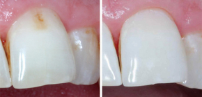 Ar yra efektyvi priemonė ar vaistas nuo dantų ėduonies?