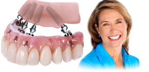 Алл-он-4 и Алл-он-6 технологије зубне протезе: сличности и разлике