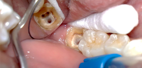 Què és la pulpitis dental: causes i perill potencial