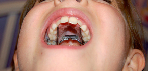 Aparatos de ortodoncia para corrección de mordida en niños.