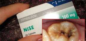 Nise-pillereiden käyttö lievittää hammassärkyä