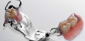 تثبيت الأطراف الاصطناعية للأسنان وأصنافها