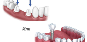 ¿Qué es mejor: puente dental o implante?