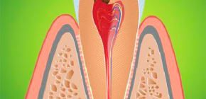 Les symptômes de la pulpite: ce qu'il est important de savoir en cas de douleur intense dans la dent